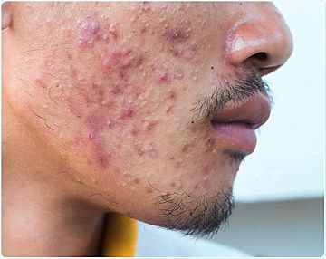 Acne esempio NewsMedical min